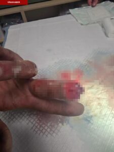 Kopan parmağını buz poşetine koyup yurt dışından Türkiye’ye geldi