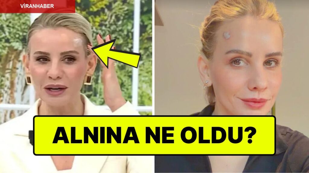 Alnındaki Yara Dikkat Çekmişti: Esra Erol Yüzünü Yaktığını Açıkladı